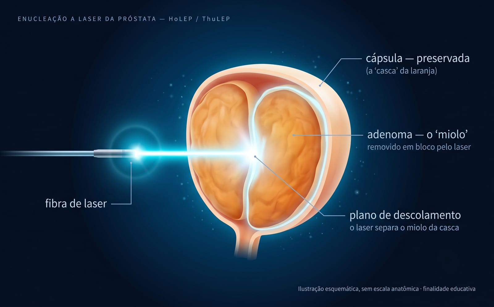 Ilustração esquemática da enucleação a Laser da próstata: o adenoma é separado da cápsula, que é preservada